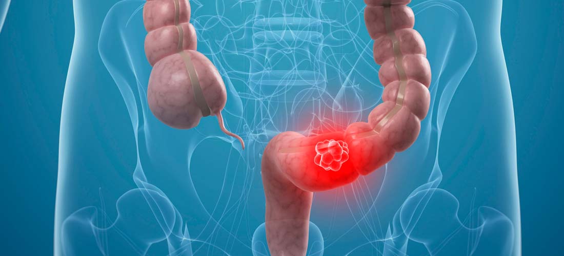 Screening for Colorectal Cancer