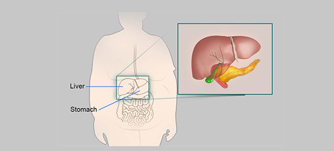 Obesity amplifies genetic risk of nonalcoholic fatty liver disease img