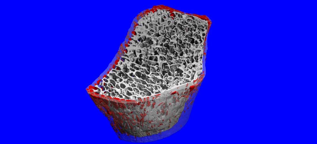 Obesity in adolescence may cause permanent bone loss img