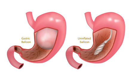 Gastric Balloon Weight Loss Procedures