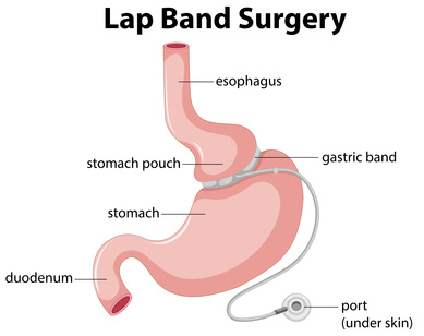 ap-Band Surgery Dallas, Gastric Sleeve Surgery Fort Worth TX