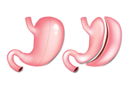 Sleeve Gastrectomy