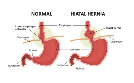 All You Need to Know about Hiatal Hernia