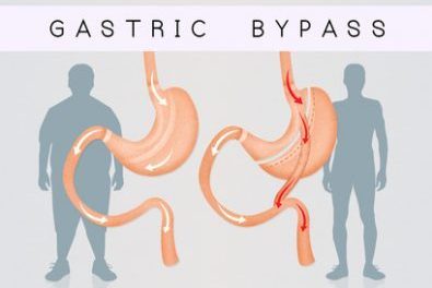 Gastric Bypass Surgery