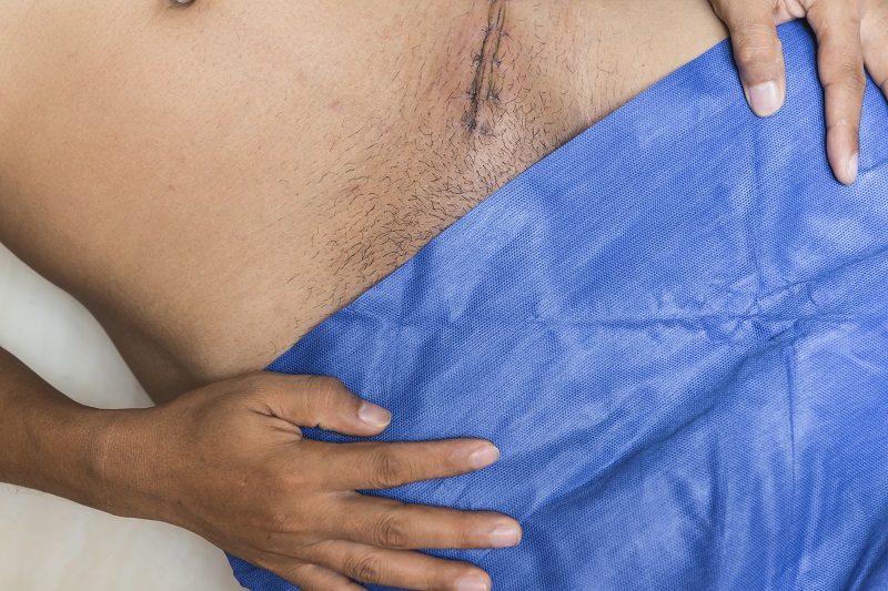 Hernia Surgery: Types, Risks, Surgery & Recovery