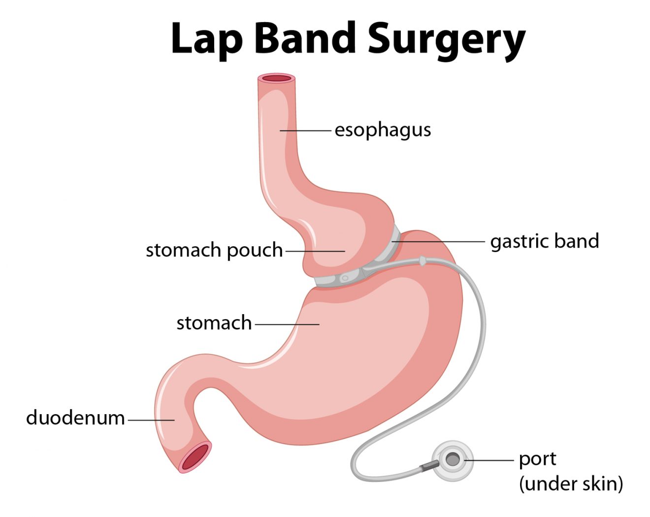 Lap-Band Surgery Dallas