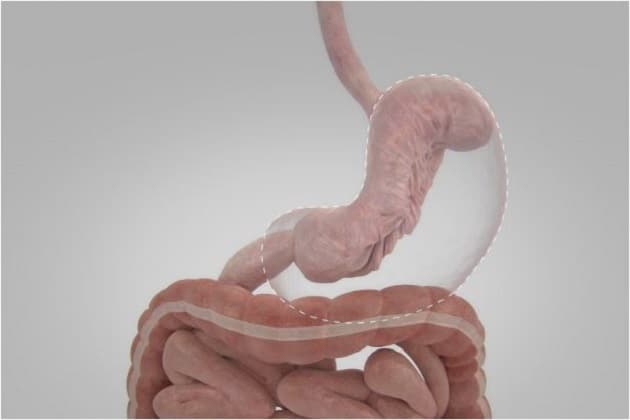 A Brief Guide To Endoscopic Sleeve Gastroplasty