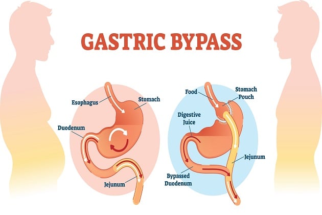 6 Major Health Benefits of Gastric Bypass Surgery