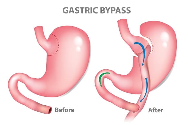 All You Need to Know About Roux-en-Y Gastric Bypass