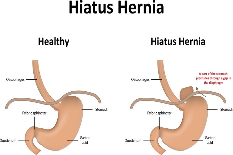 4 Lesser Known Facts About Hiatal Hernia DFW Bariatrics and General
