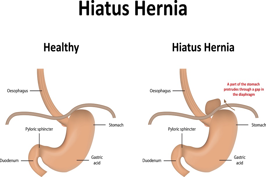 4 Lesser Known Facts About Hiatal Hernia