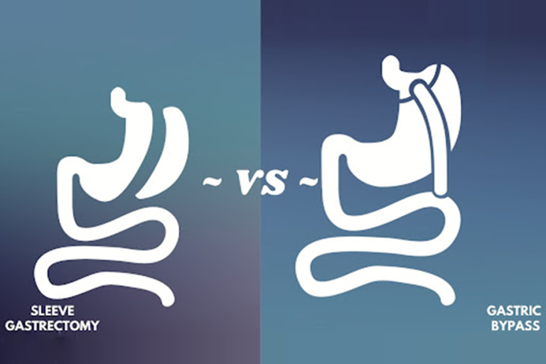 Sleeve Gastrectomy Vs Gastric Bypass Differences & Similarities