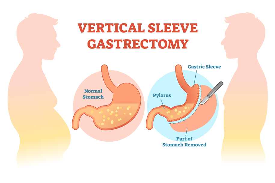 Sleeve Gastrectomy Weight loss surgery