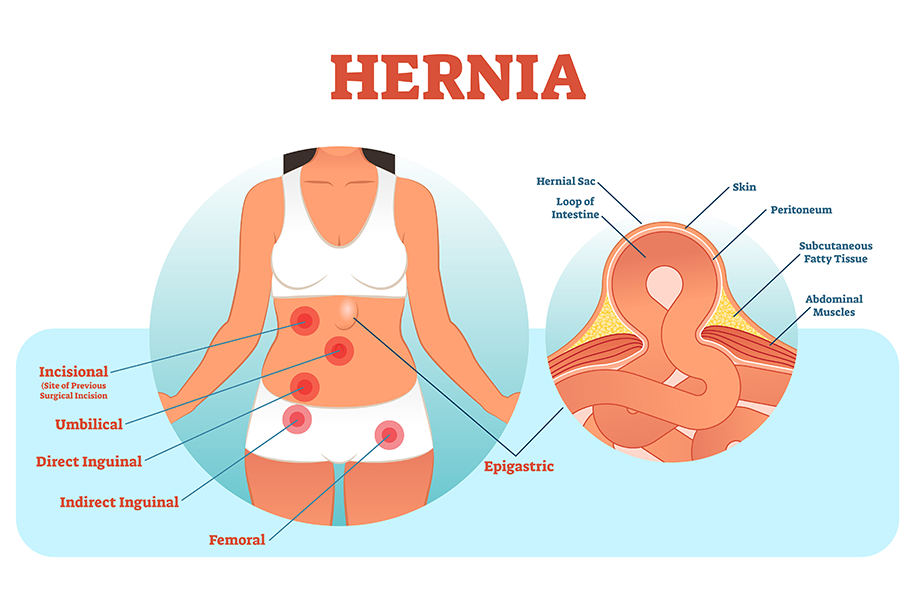 Symptoms That Necessitate Hernia Surgery