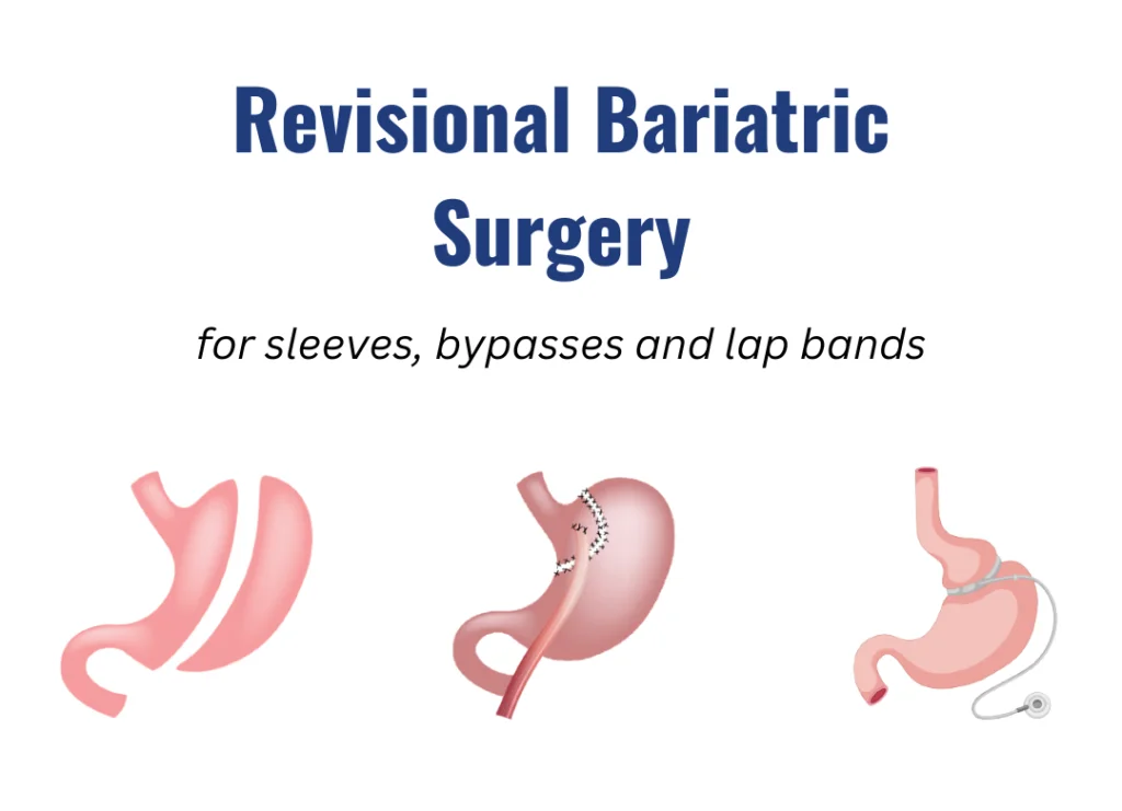 Revision Weight Loss Surgery Dallas, Fort Worth, Mansfield & Plano, TX