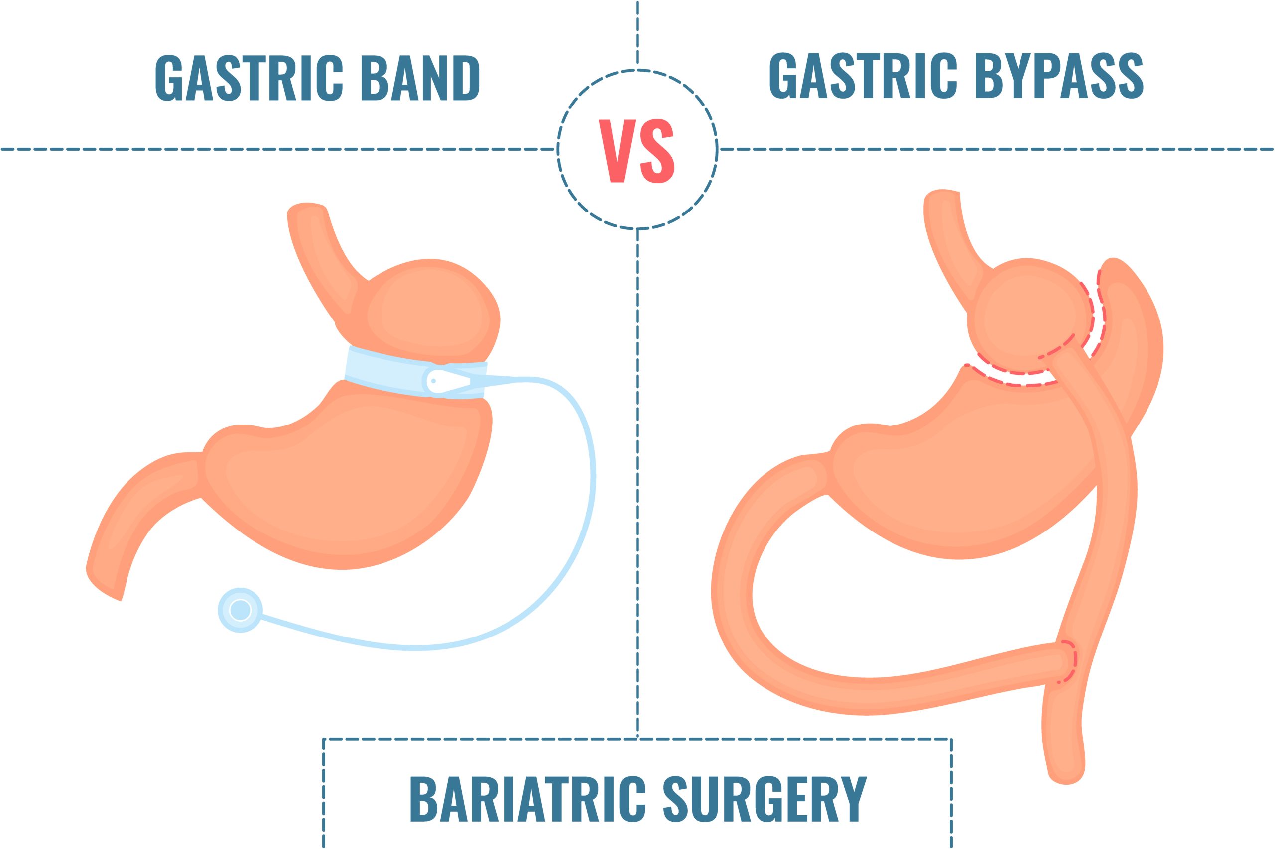 Navigating Recovery: Understanding Band to Bypass Revision for Optimal Healing