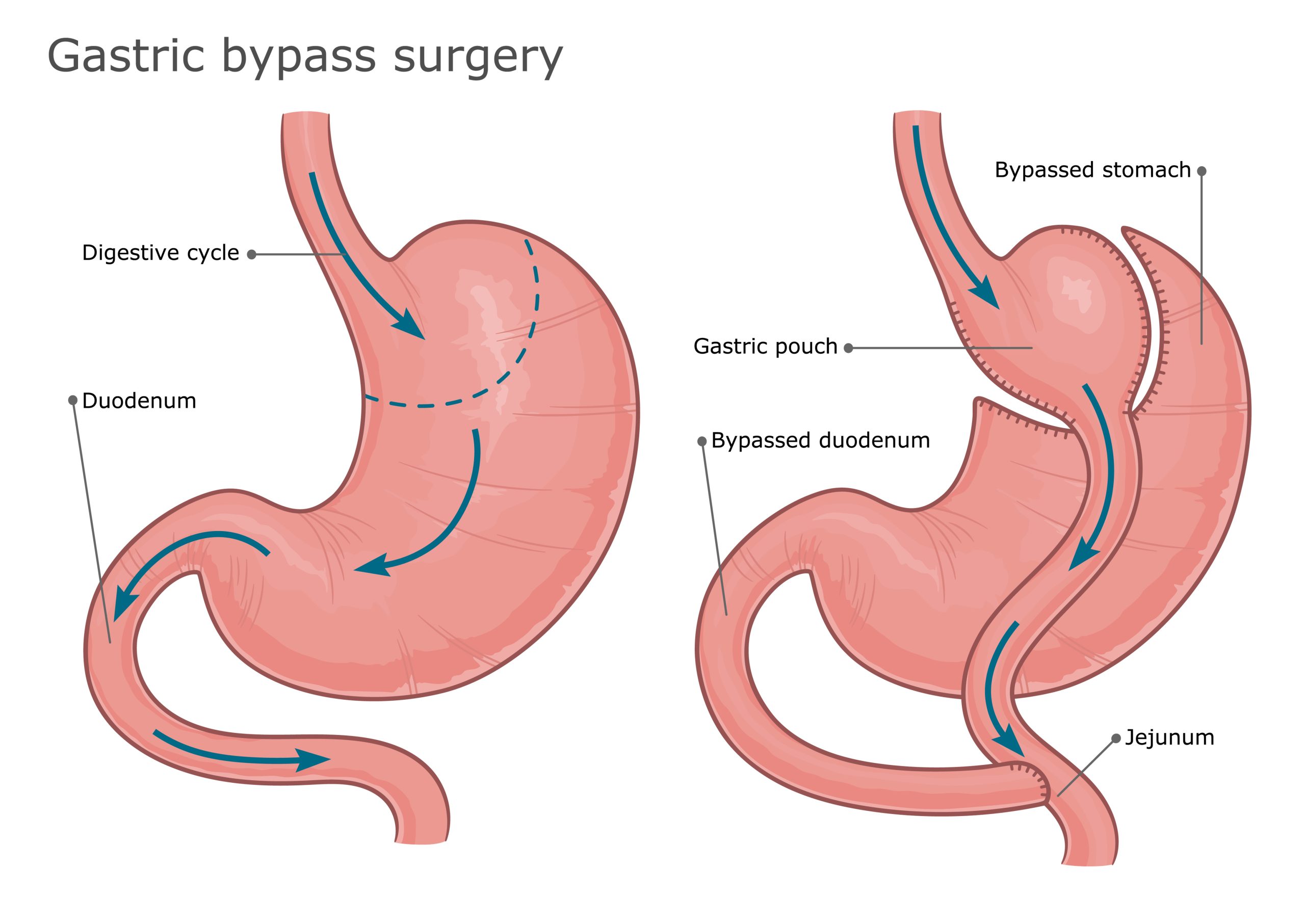Gastric Bypass Surgery — Expectations Vs Reality