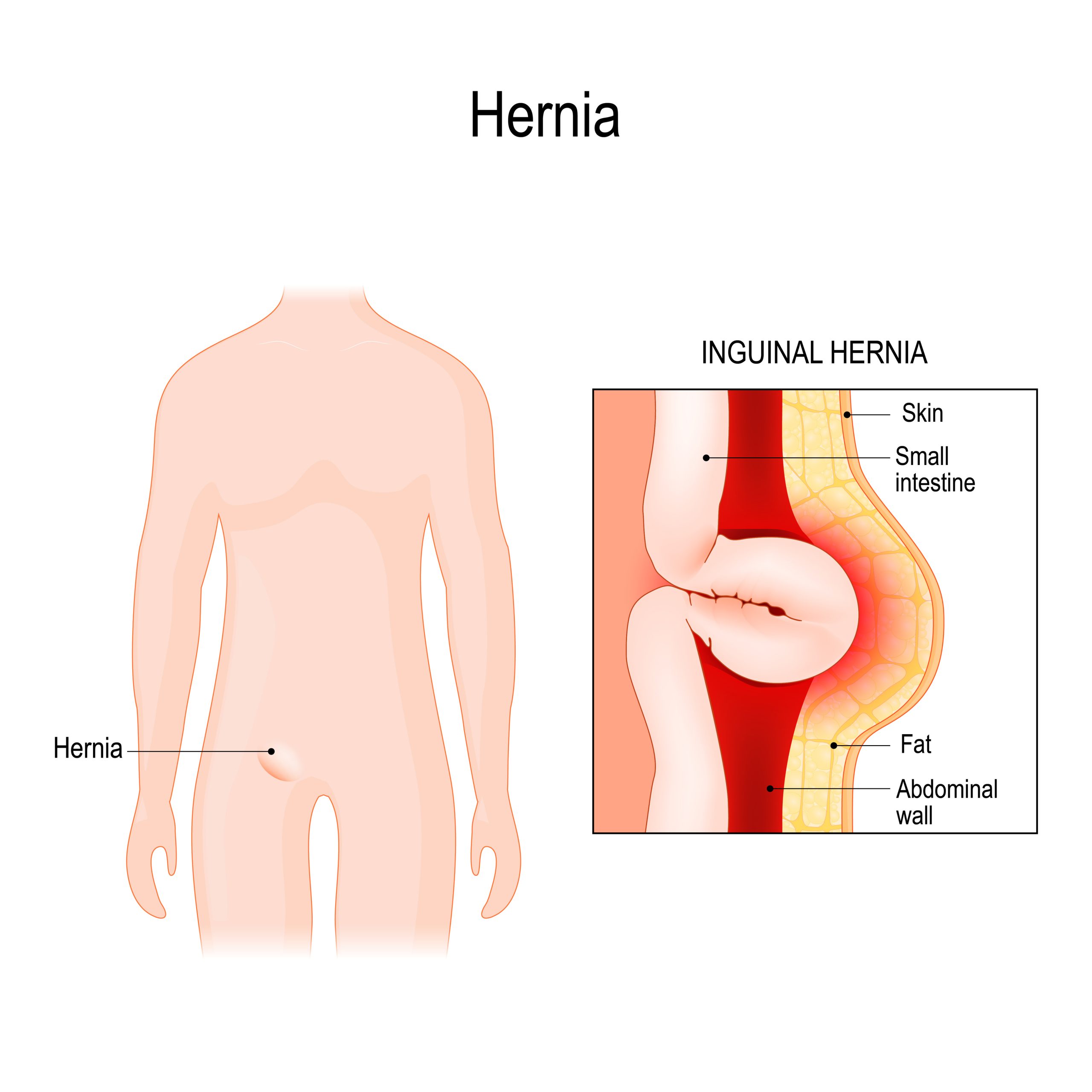 Strategies for Accelerated Recovery from Hernia Surgery