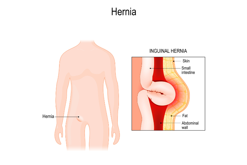 Strategies for Accelerated Recovery from Hernia Surgery