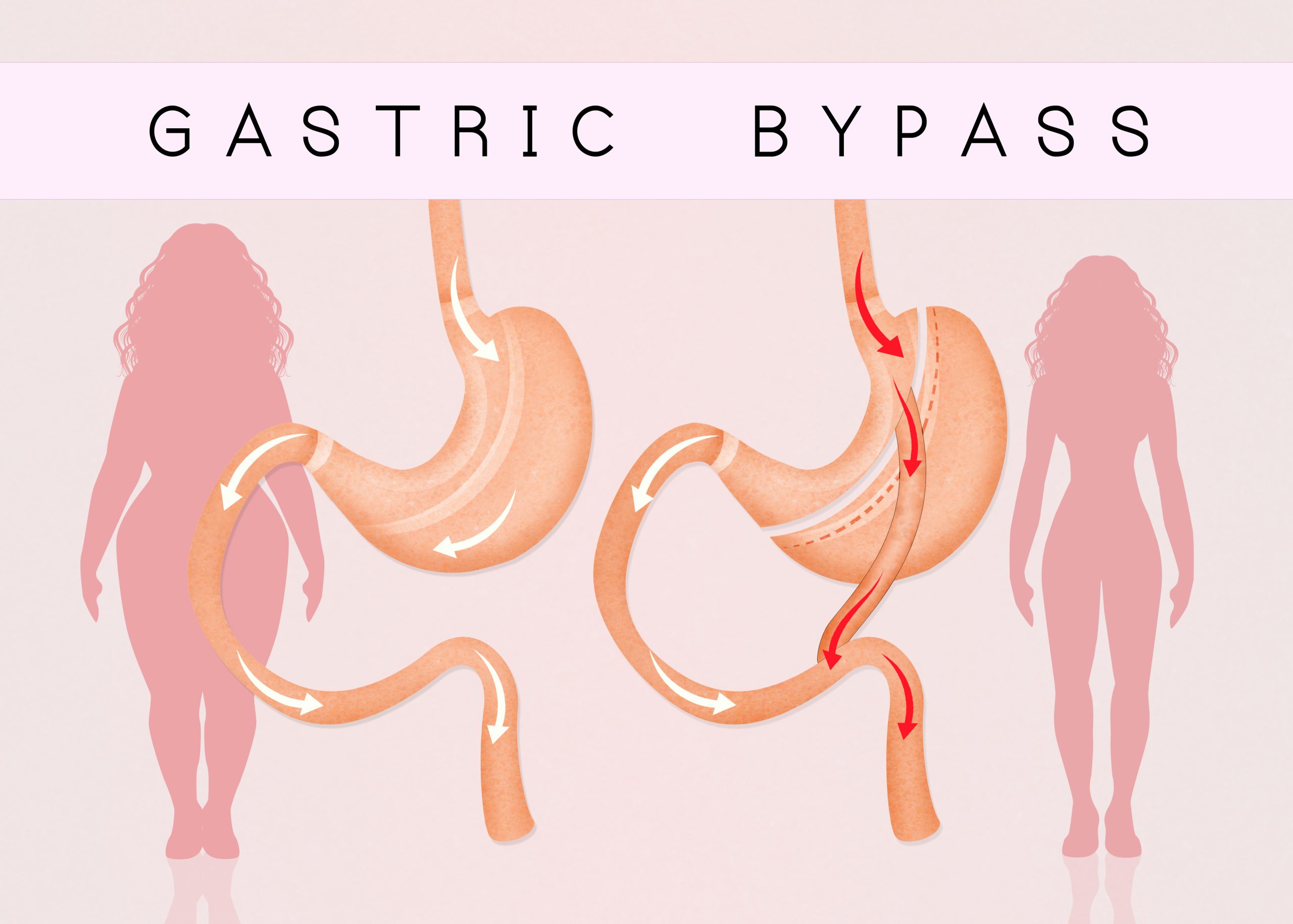 Living with Gastric Bypass: Managing Common Side Effects