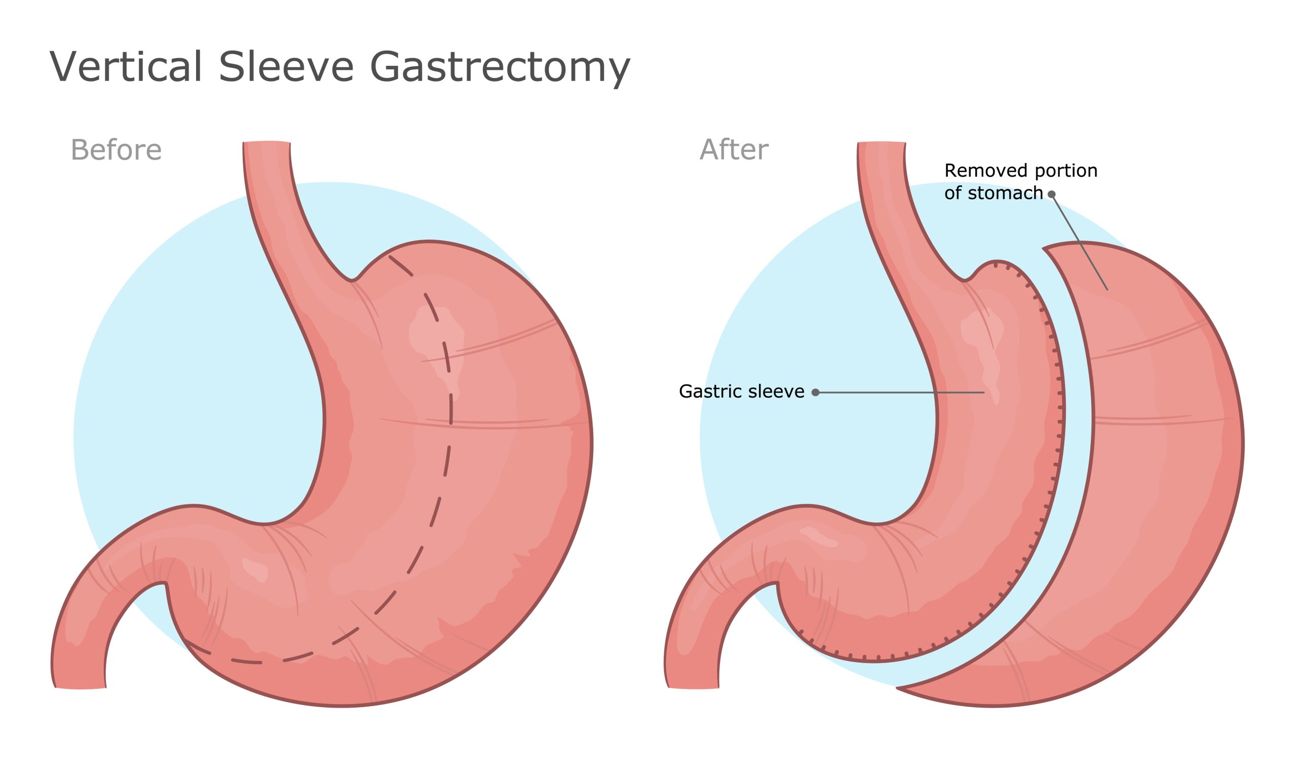Evaluating Success and Long-Term Complications in Sleeve Gastrectomy