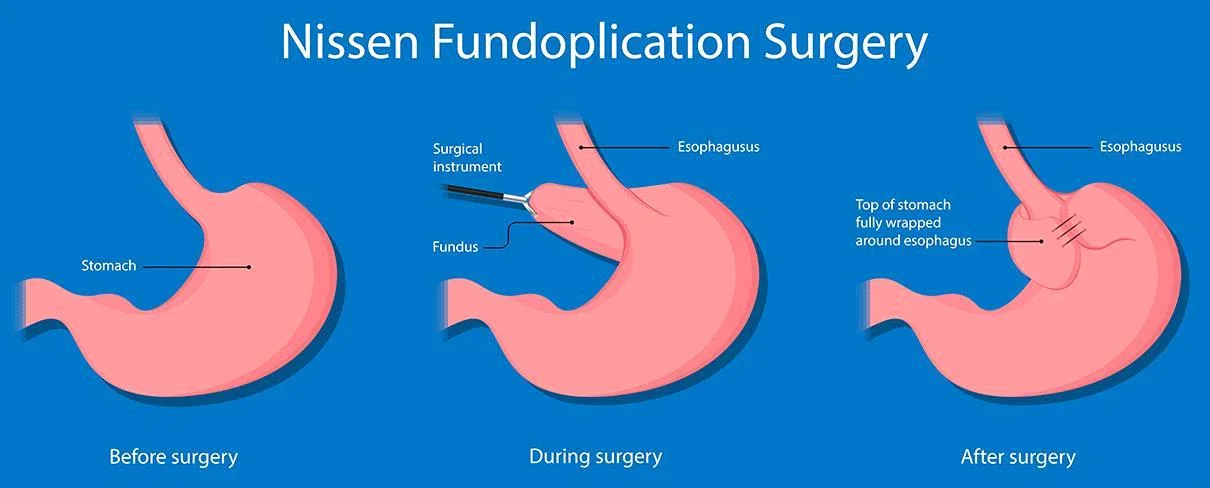 Nissen fundoplication and LINX surgery for GERD